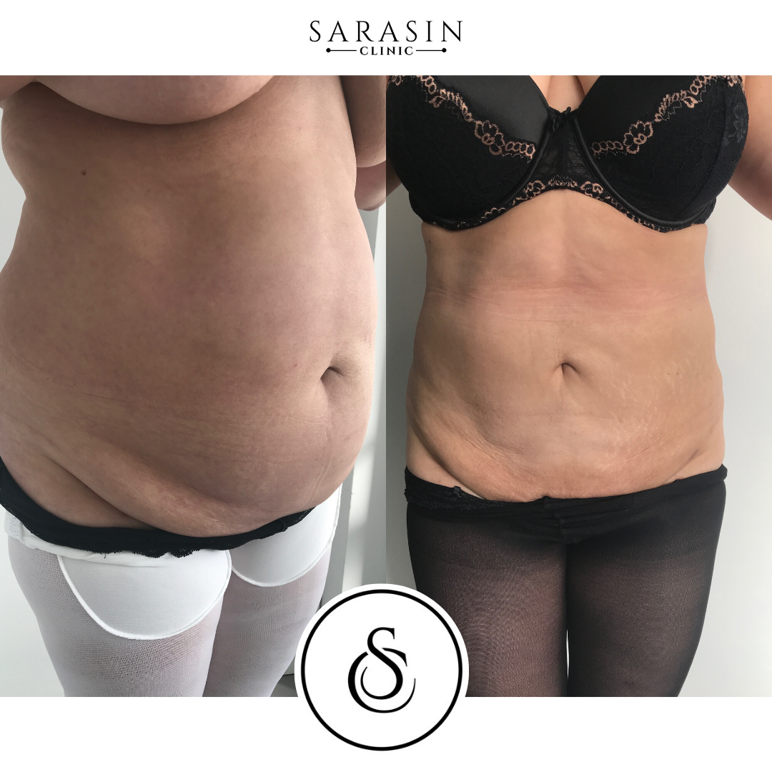liposuctie 1 before and after sarasin clinic