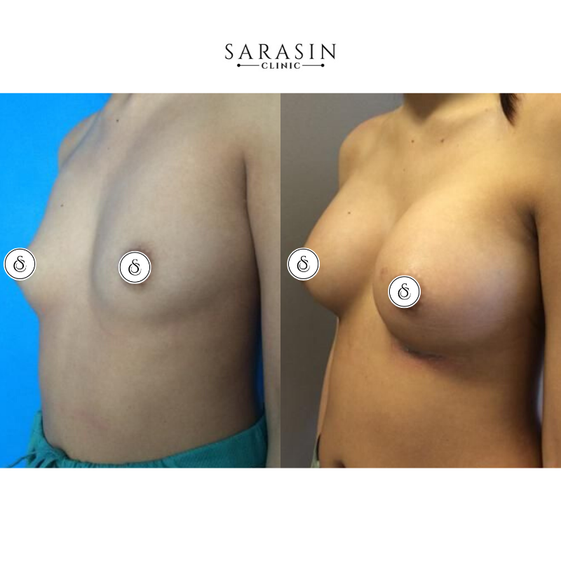 augmentation mammaire de la clinique sarasin avant et après photo