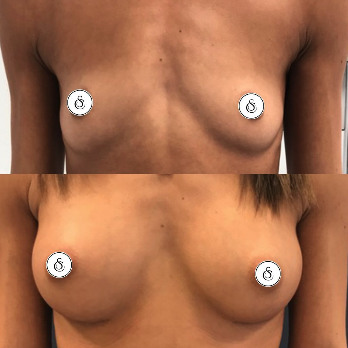 borstvergroting voor en na foto sarasin clinic