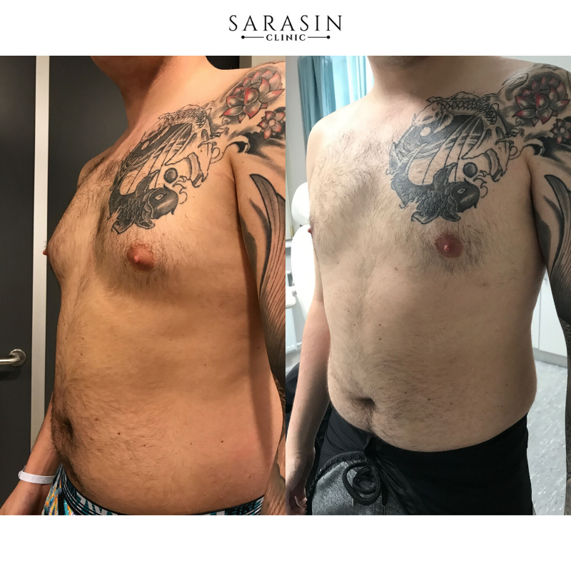 Homme avec un tatouage sur la poitrine avant et après une opération des menboobs.