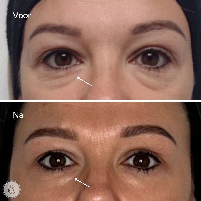 Sarasin Clinic RRS Eyes before and after