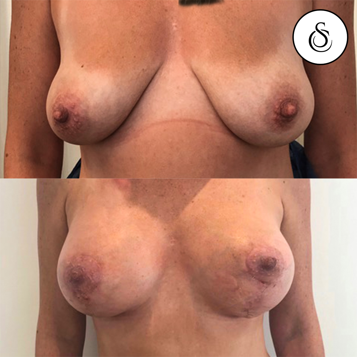 Lifting mammaire avant et après la photo