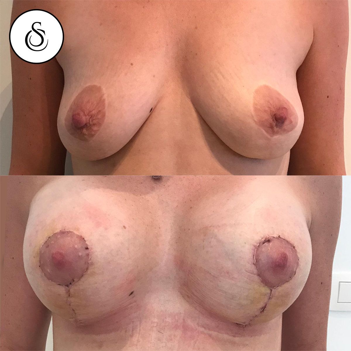 photo d'augmentation mammaire avant et après