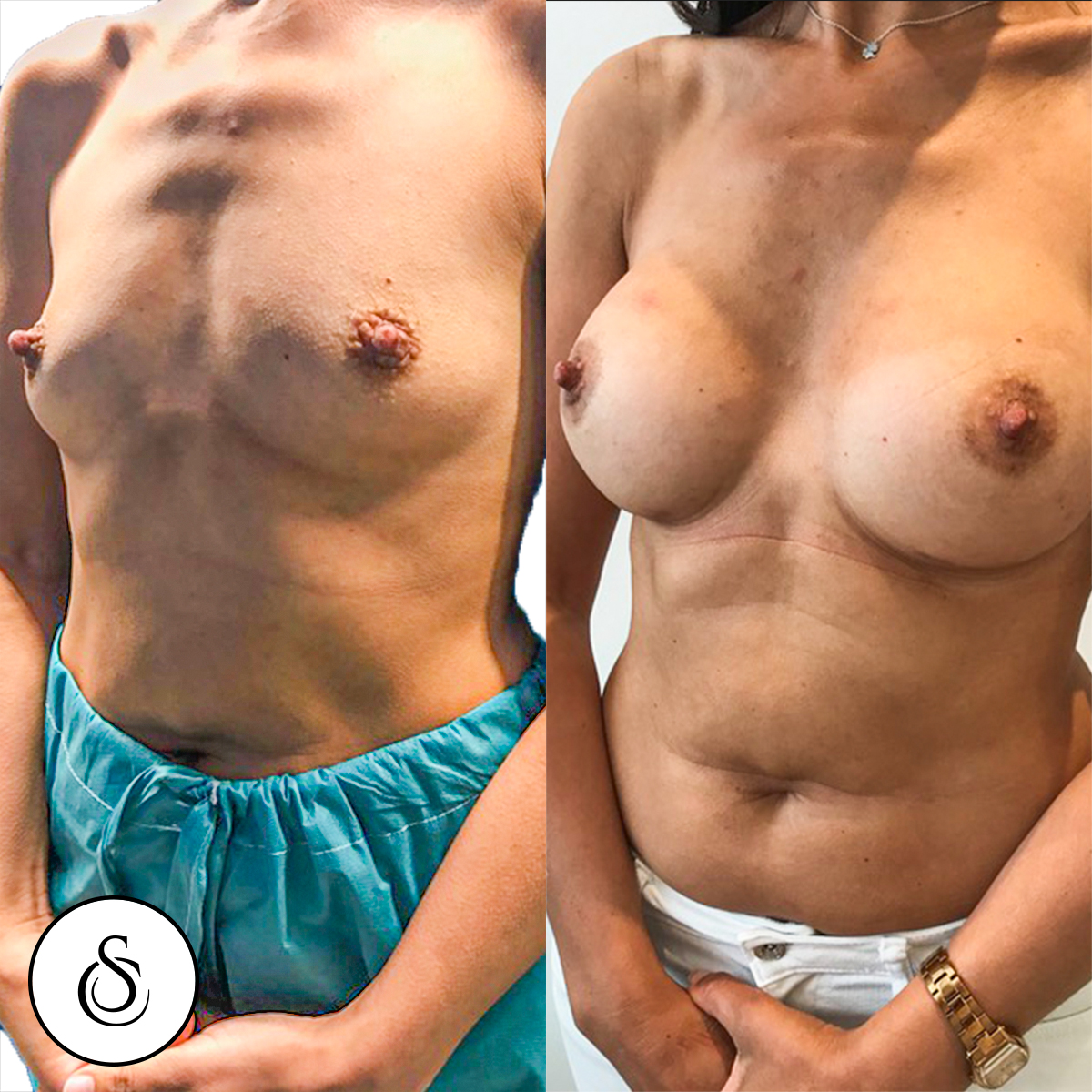 borstvergroting vrouw before en after foto