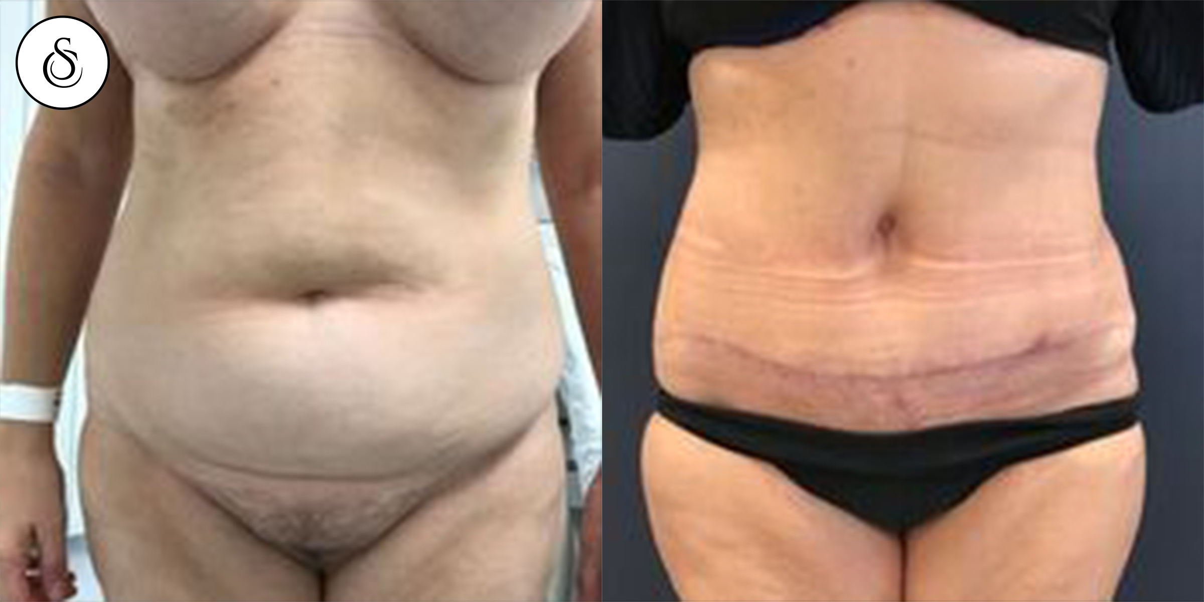 plastie abdominale petite liposuccion femme avant et après
