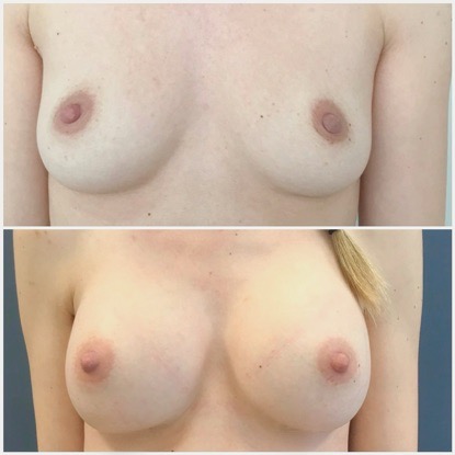 Augmentation mammaire avec prothèses avant et après photo