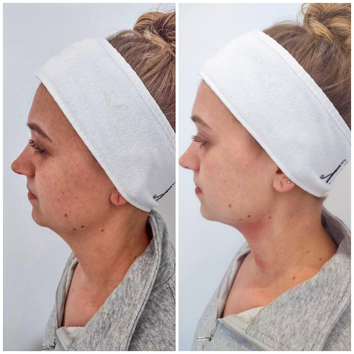 Jeune femme aux joues tombantes traitement hifu avant et après