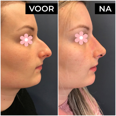 Sarasin Clinic neuscorrectie jonge vrouw zijaanzicht haakneus voor en na