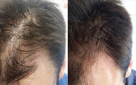 Sarasin Clinic Hair Filler behandeling