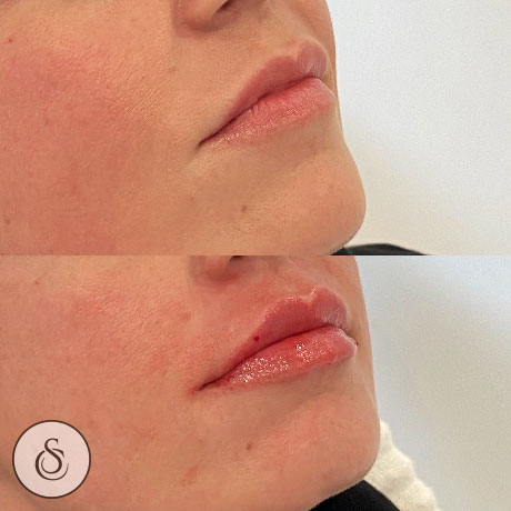 Sarasin Clinic Ghent lip filler avant et après