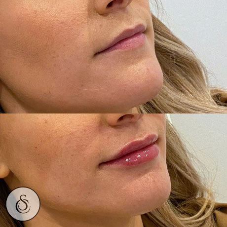 Clinique Sarasin - Comblement des lèvres avant et après - femme