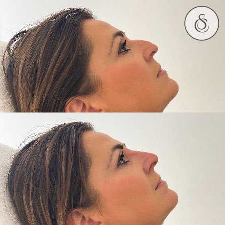 Sarasin Clinic neusfiller zijkant vrouw haakneus voor en na