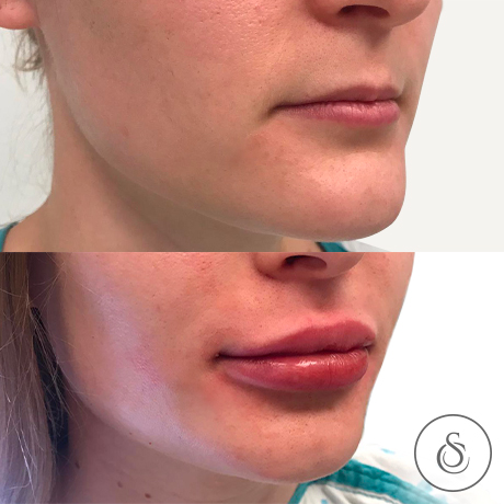 Sarasin Clinic lipofilling lips zijkant