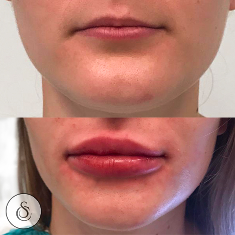Sarasin Clinic lipofilling lips frontaal