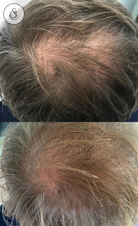 Sarasin Clinic haarfiller voor en na bij man