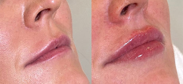 Lippen opvullen met eigen vet of hyaluronzuur?