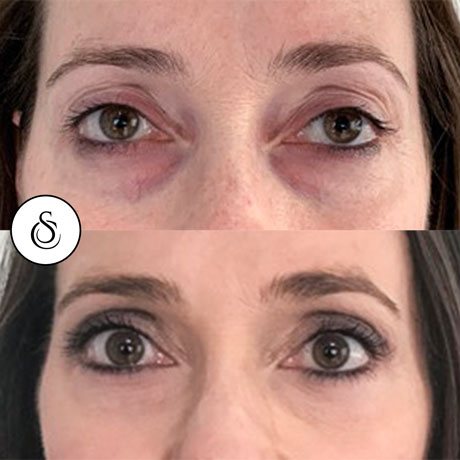 Sarasin Clinic ooglidcorrectie boven voor en na vrouw