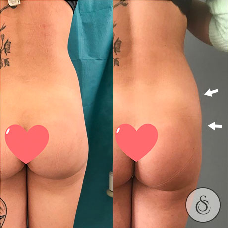 Augmentation de la hanche à la clinique Sarasin avant et après