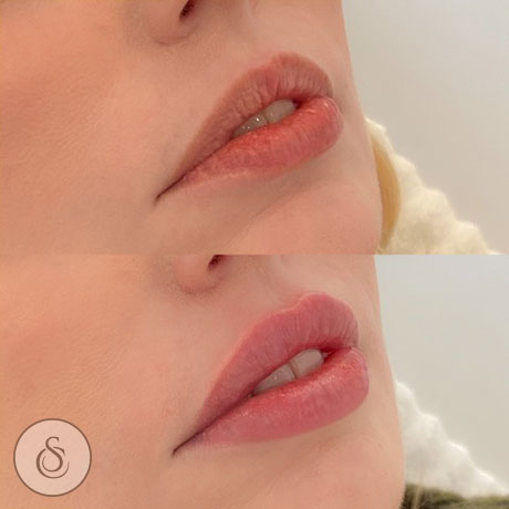 Clinique Sarasin - Comblement des lèvres avant et après - femme