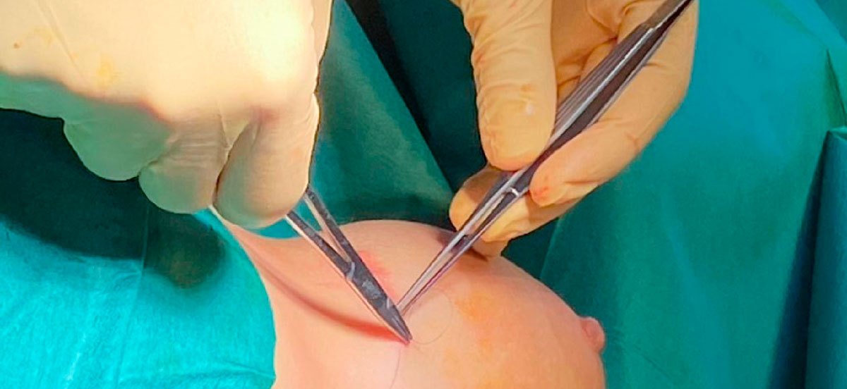Sarasin Clinic incisie borst