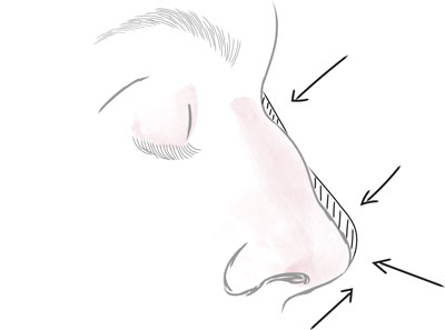 Sarasin Clinic neusfiller voor bult tekening