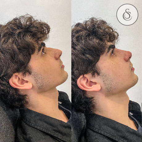 Sarasin Clinic neusfiller voor bult voor en na jonge man