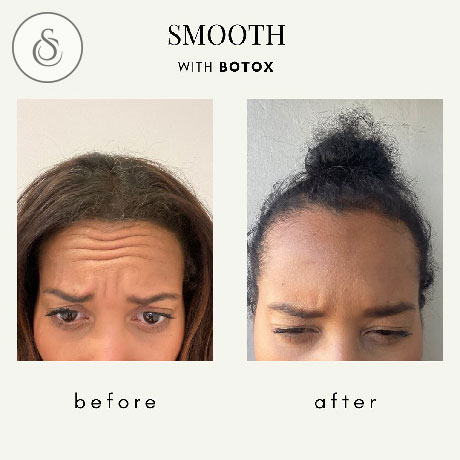 Clinique Sarasin botox avant et après