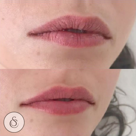 Hydratation des lèvres de la clinique Sarasin avant et après