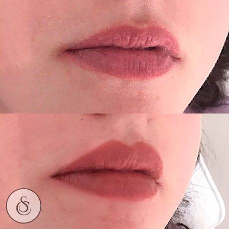 lip fillers Clinique Dr Doornaert Sarasin