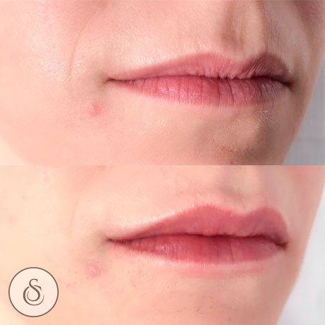 lip fillers Clinique Dr Doornaert Sarasin