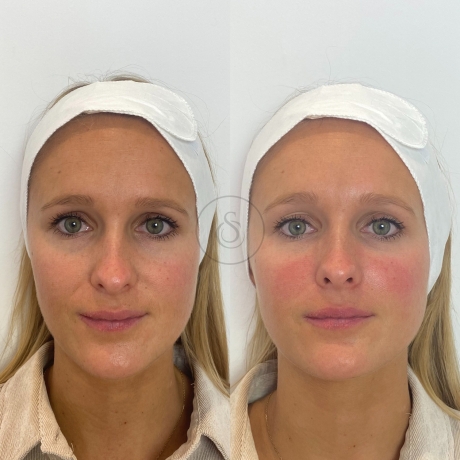 Sarasin Clinic - voor en na neus lipplooi