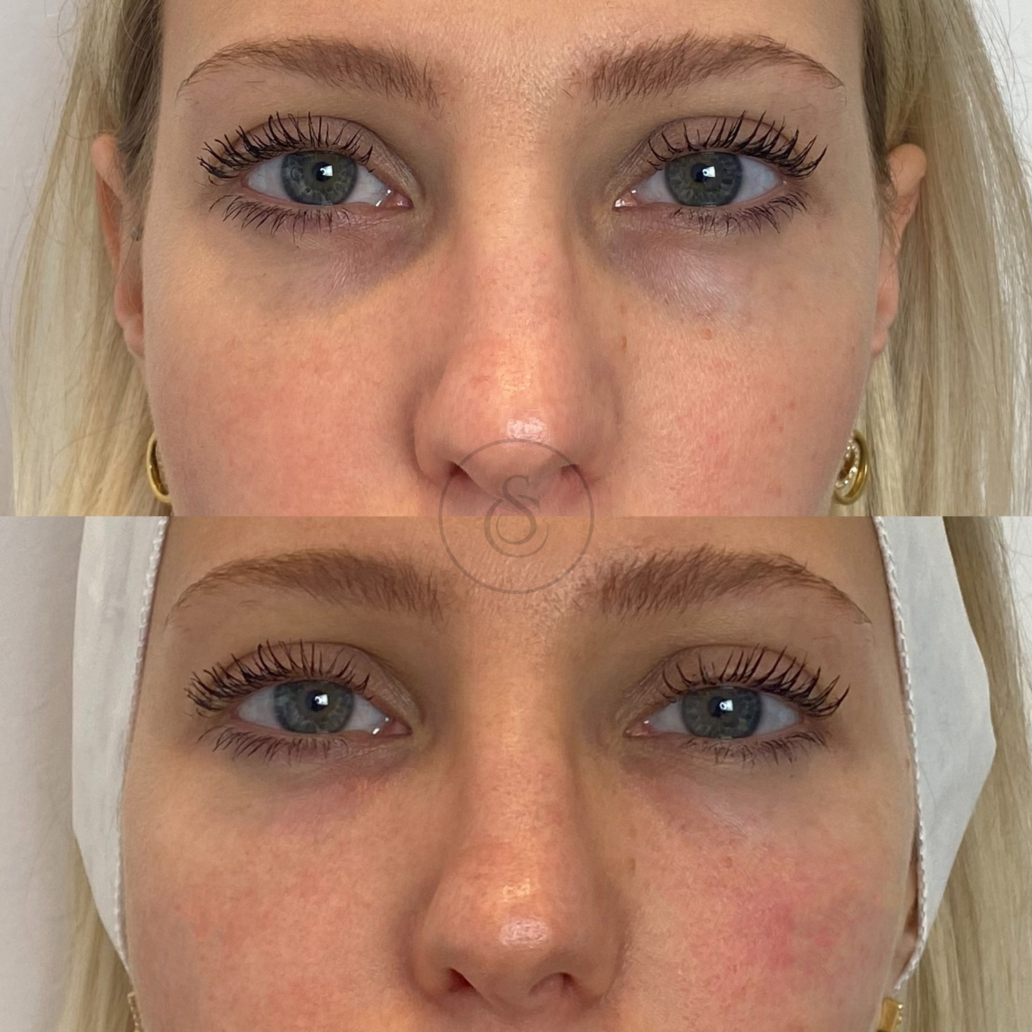 Clinique Sarasin - avant et après le remplissage du canal lacrymal