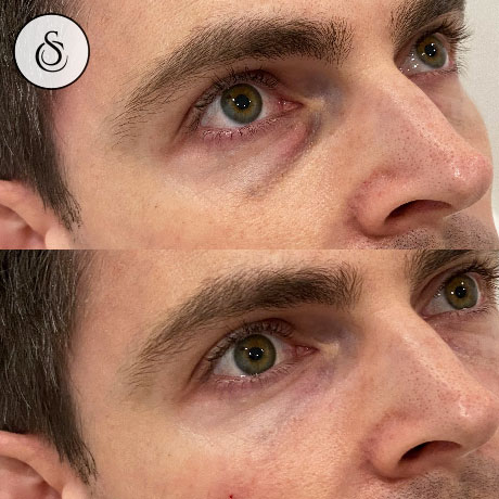 Clinique Sarasin - avant et après le remplissage du canal lacrymal