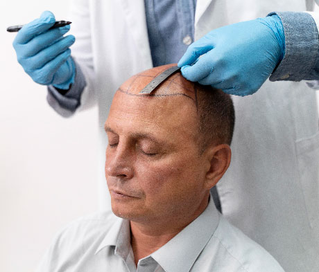 Sarasin Clinic haartransplantatie man