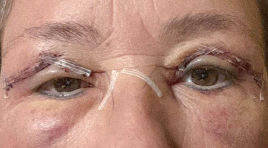 Sarasin Clinic ooglidcorrectie na operatie