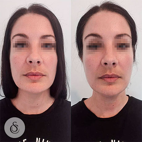 HIFU facelift without surgery - from €150