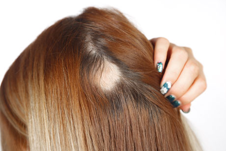 Sarasin Clinic vrouw alopecia haarfiller