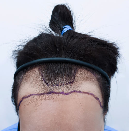 Sarasin Clinic haartransplantatie vrouw