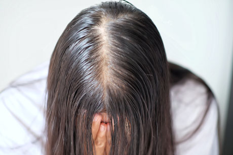 Sarasin Clinic haaruitval vrouw haarfiller