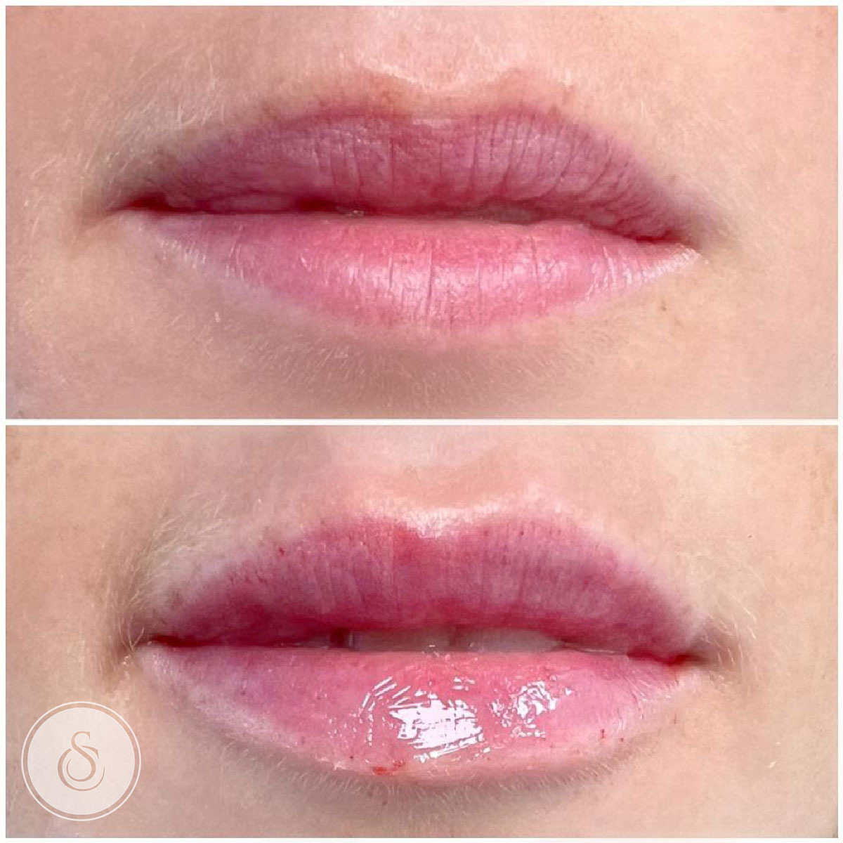 Clinique Sarasin - Comblement des lèvres avant et après