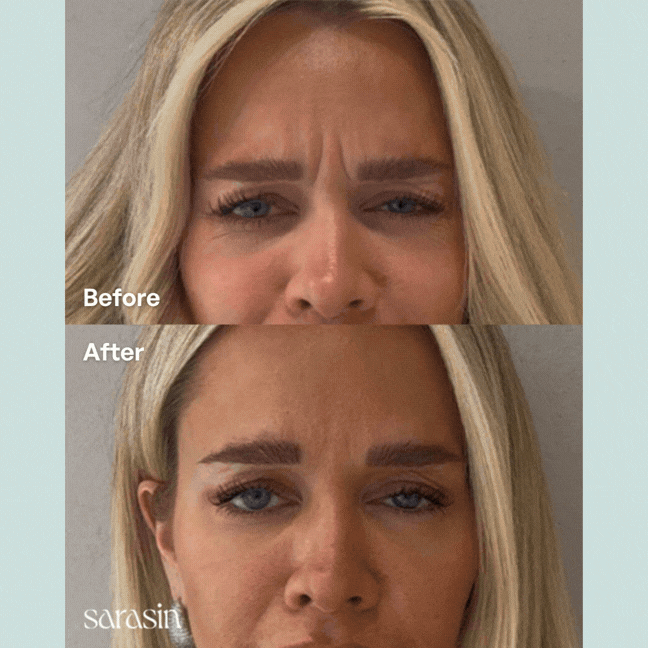botox voorhoofd rimpels resultaten