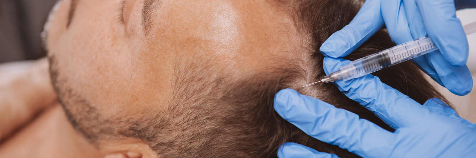 Les implants capillaires : la solution à la perte de cheveux
