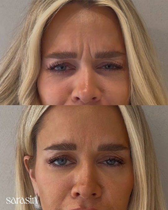 fronsrimpel botox behandeling voor en na