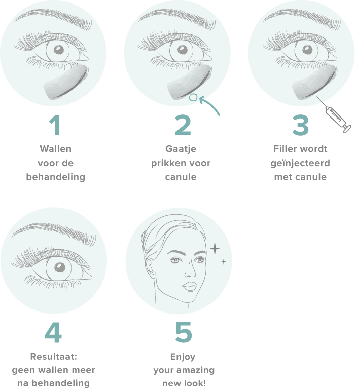 tear trough filler treatment