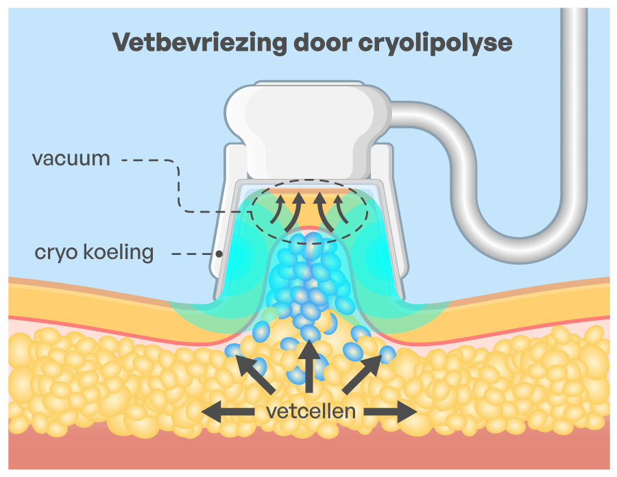 Cryolipolyse-werking-sarasin