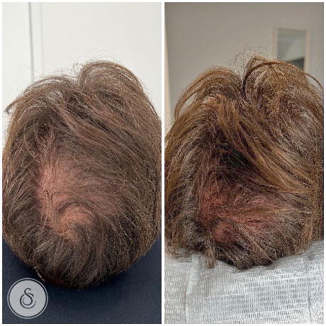 Sarasin Clinic Haarfiller Man voor en na