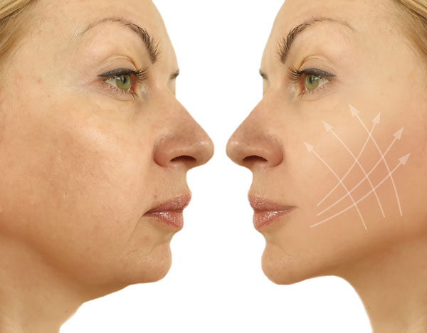 Sarasin Clinic fillers gezicht facelift