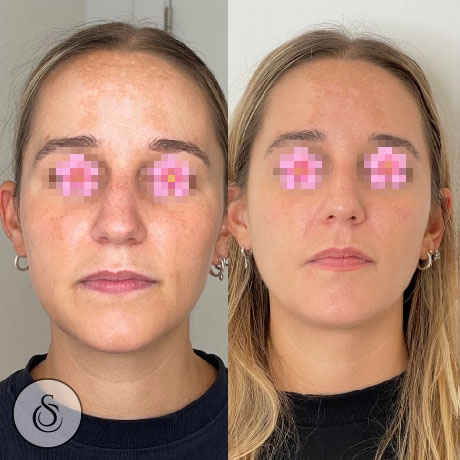 profhilo face woman before and after