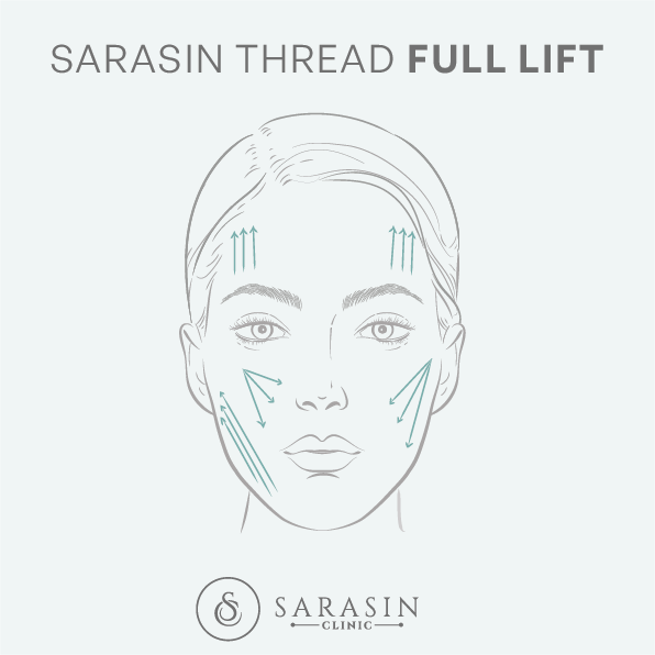 Sarasin Clinic draadlift full lift