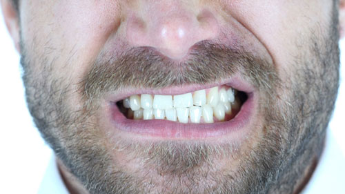 Sarasin Clinic bruxisme tandenknarsen